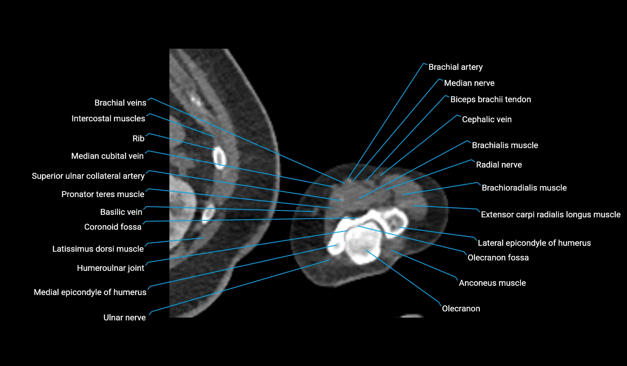 CT upper arm axial  cross sectional anatomy labelled radiology image -00376.webp